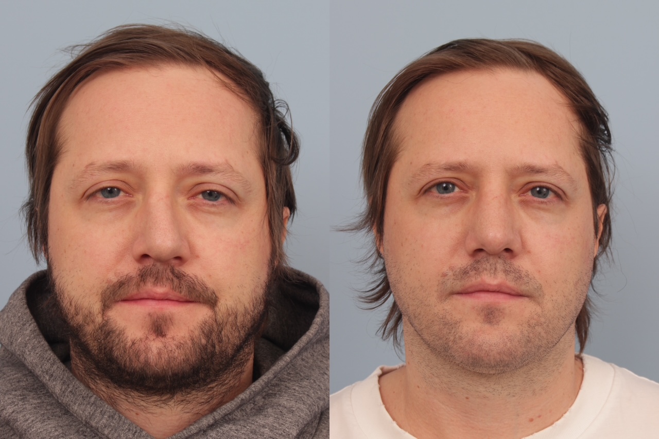 before_after_img