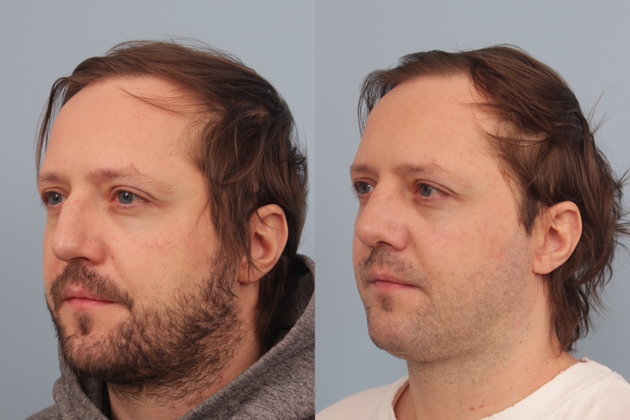 before_after_img