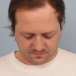 rhinoplasty-after
