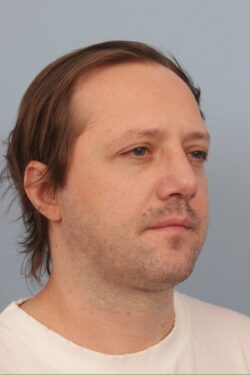 after rhinoplasty