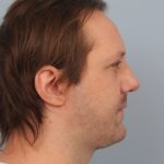 rhinoplasty-after