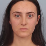 rhinoplasty-after