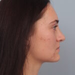 rhinoplasty-after