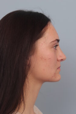 after rhinoplasty