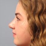 rhinoplasty-after