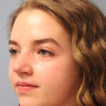rhinoplasty-after