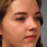 rhinoplasty-after