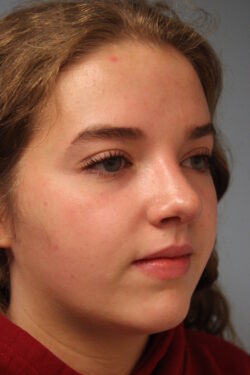 after rhinoplasty