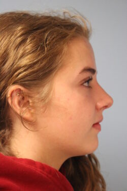 after rhinoplasty