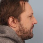 rhinoplasty-before