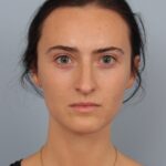 rhinoplasty-before