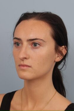 before rhinoplasty