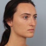 rhinoplasty-before