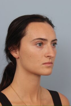 before rhinoplasty