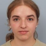 rhinoplasty-before