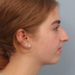 rhinoplasty-before