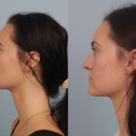 rhinoplasty-merged