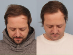 before and after rhinoplasty