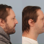 rhinoplasty-merged