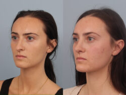 before and after rhinoplasty
