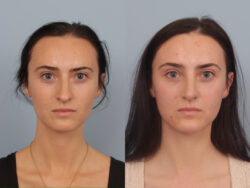 before and after rhinoplasty