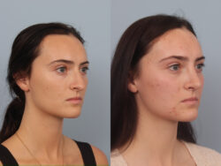 before and after rhinoplasty