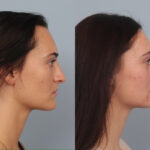 rhinoplasty-merged
