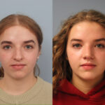 rhinoplasty-merged