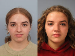 before and after rhinoplasty