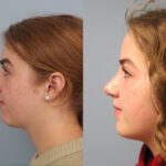 rhinoplasty-merged