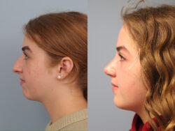 before and after rhinoplasty