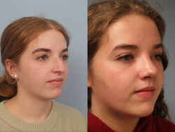 before and after rhinoplasty