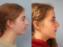 before and after rhinoplasty