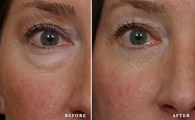 blepharoplasty