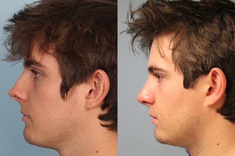 before_after_img