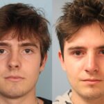 rhinoplasty-merged