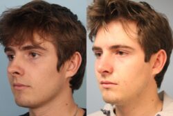 before and after rhinoplasty