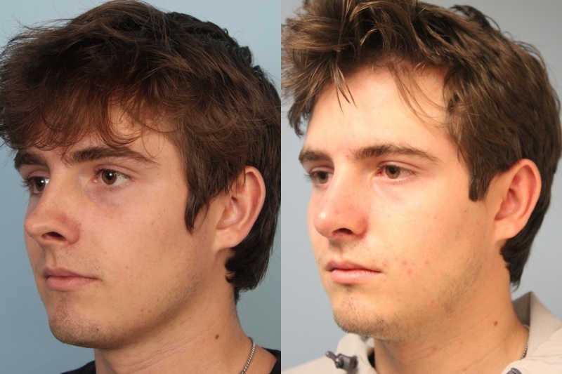 before_after_img