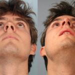 rhinoplasty-merged