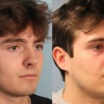 rhinoplasty-merged