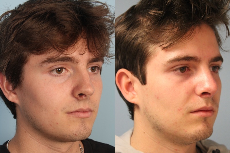 before_after_img