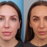 rhinoplasty-merged