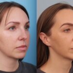 rhinoplasty-merged