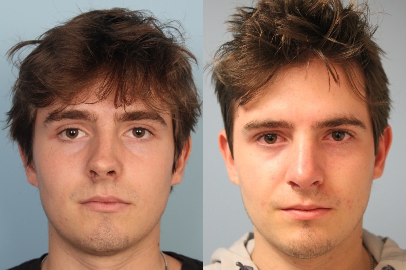 before_after_img