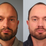 FacesFirst-Gallery-Rhinoplasty-165-Front