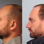 FacesFirst-Gallery-Rhinoplasty-165-Left