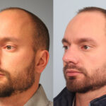 FacesFirst-Gallery-Rhinoplasty-165-Left-OBL