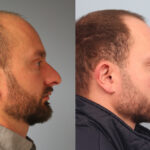 FacesFirst-Gallery-Rhinoplasty-165-Right