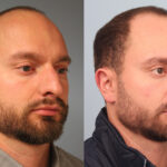 FacesFirst-Gallery-Rhinoplasty-165-Right-OBL