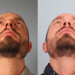FacesFirst-Gallery-Rhinoplasty-165-Under